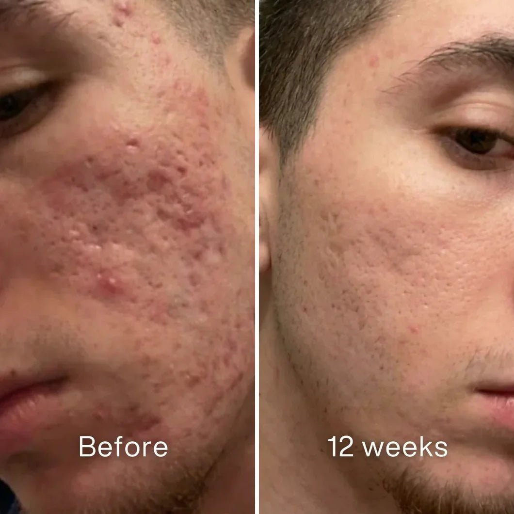 Clinical Acne Scar Stick